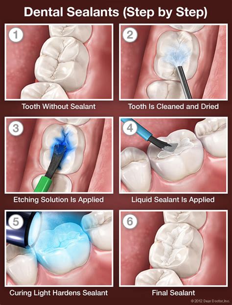 teeth sealant cost.